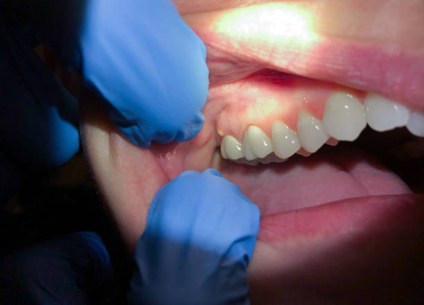 Best Emergency Wisdom Tooth Extraction in Mills River, NC